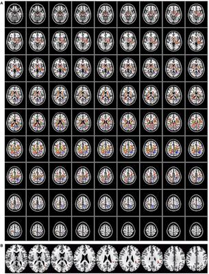 On the Relationship Between White Matter Structure and Subjective Pain. Lessons From an Acute Surgical Pain Model